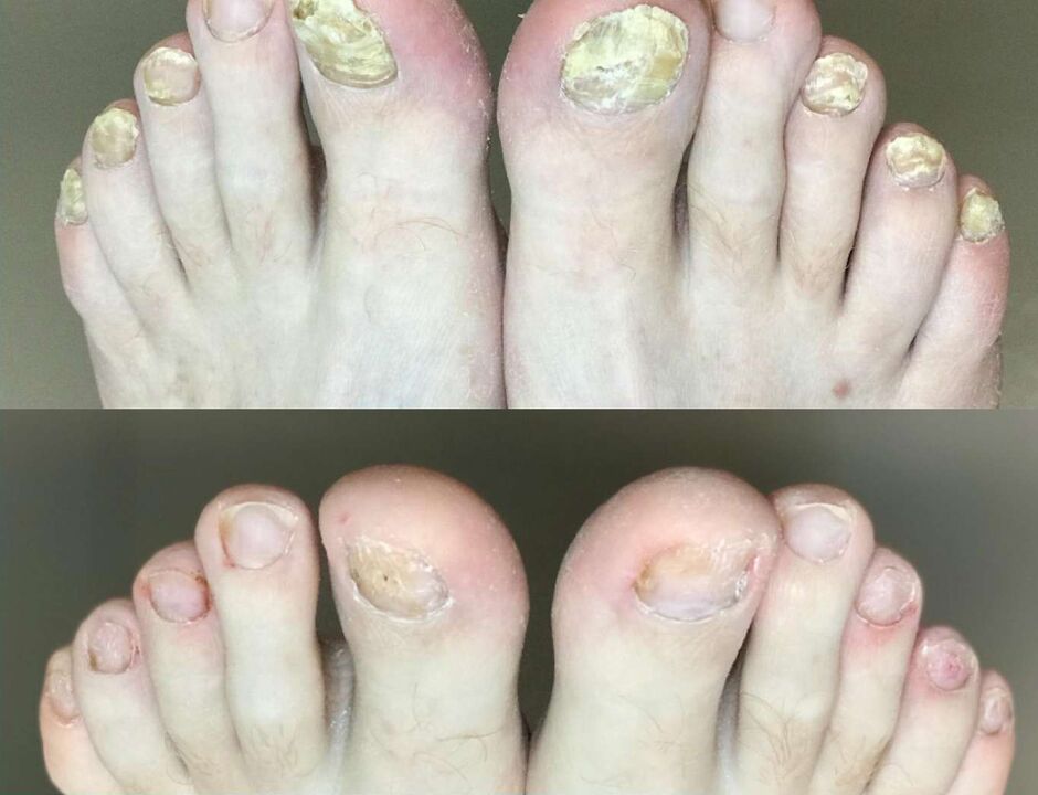 Before and after treatment the mushroom promisil cream