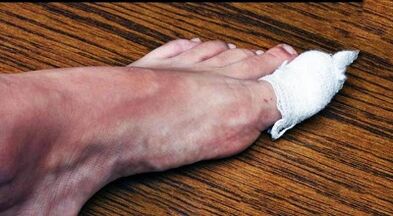 Compresses the treatment of the mushroom on the thumb of the leg