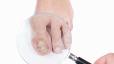 How to treat a mushroom at the thumb of the leg