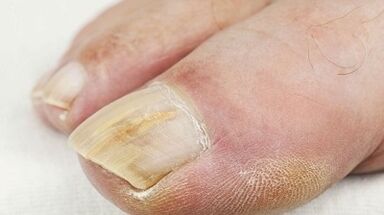 The reasons for the appearance of the mushroom on the thumb of the leg