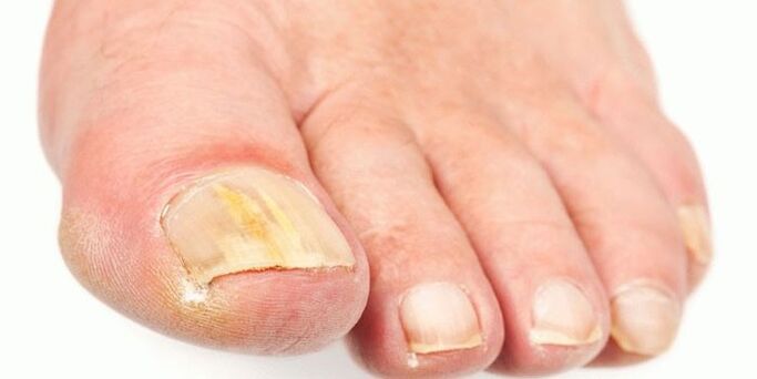 Effective products from nail fungus