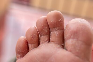 Symptoms of toe fungus