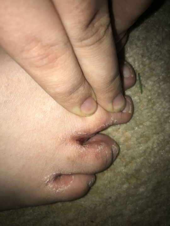 Toe fungal infection