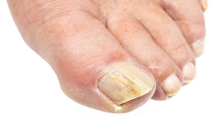 External changes on the nail are a sign of a fungal infection