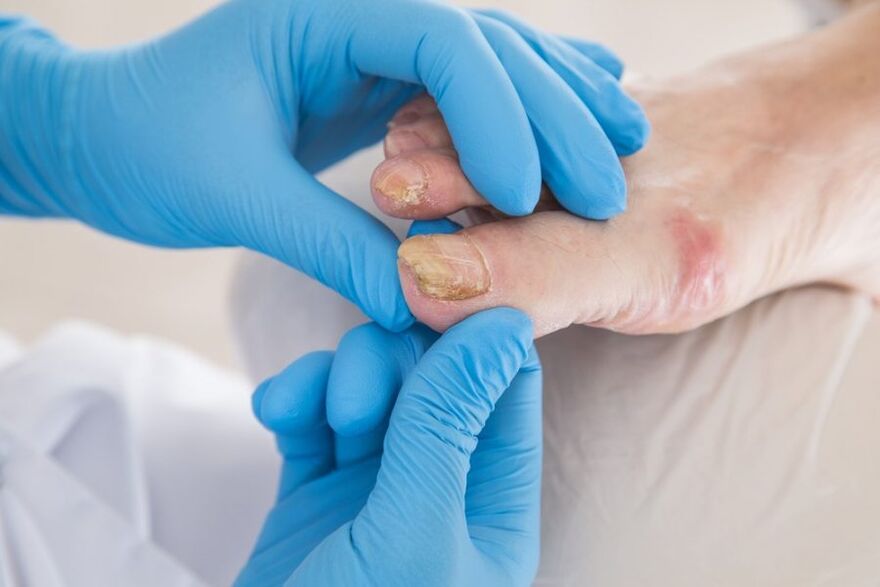 Nail plates affected by fungus