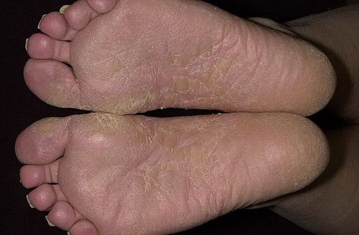 Dry, flaky skin on the feet is a sign of dandruff