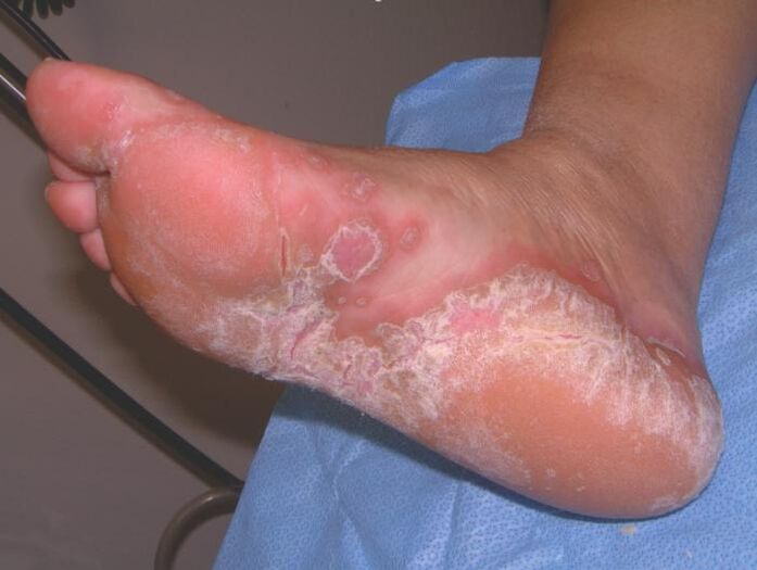 Foot affected by a fungal infection