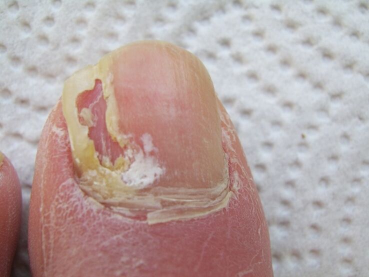 Onychomycosis involves deformation of the nail plate