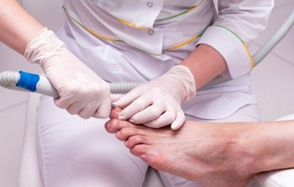 Treatment procedure for toenail fungus